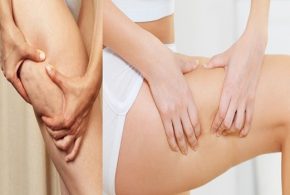 6 Wonderful Methods to Treat Cellulite
