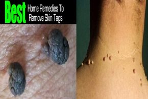 How to Naturally Remove Skin Tags At Home