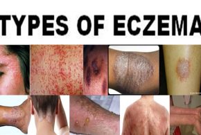 MORE ABOUT ECZEMA: ITS TRIGGERS & TYPES